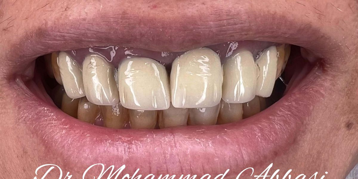 Porcelain veneers case 12, before treatment