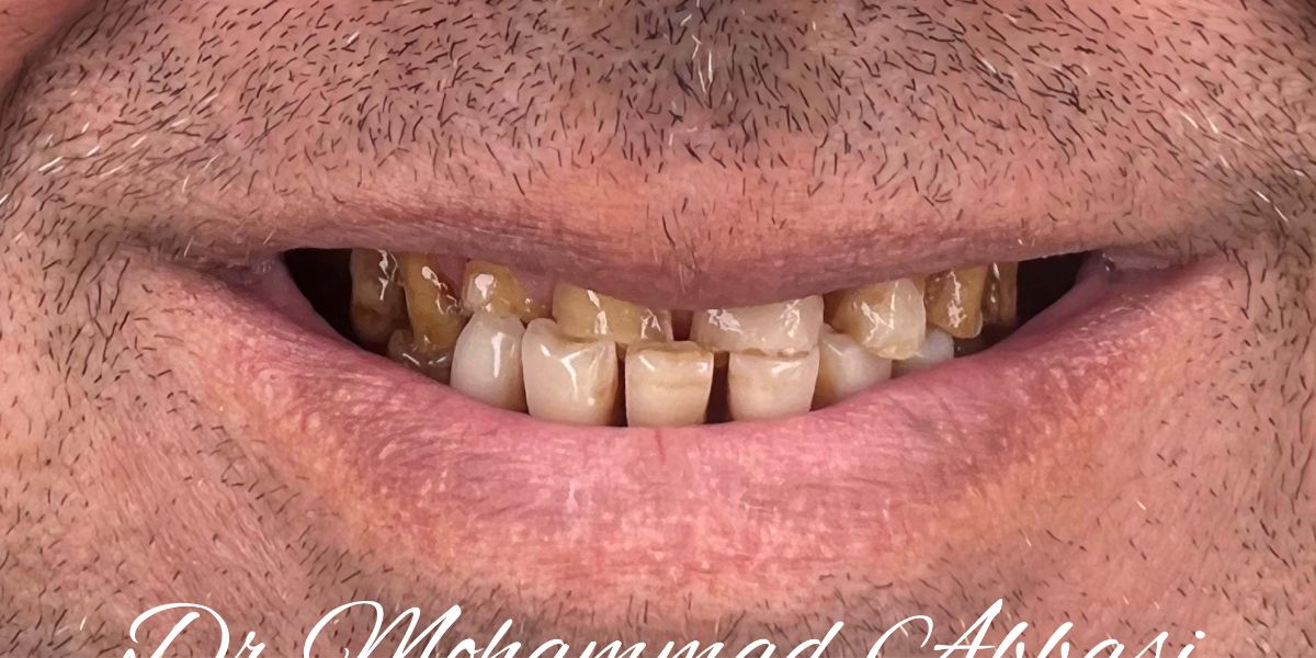 Porcelain veneers case 13, before treatment