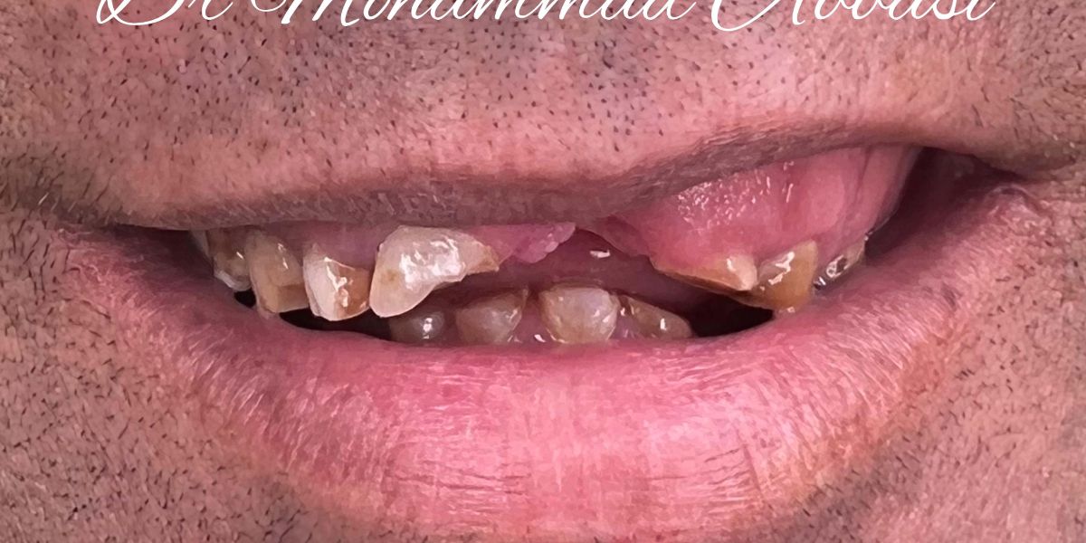 Porcelain veneers case 15, before treatment