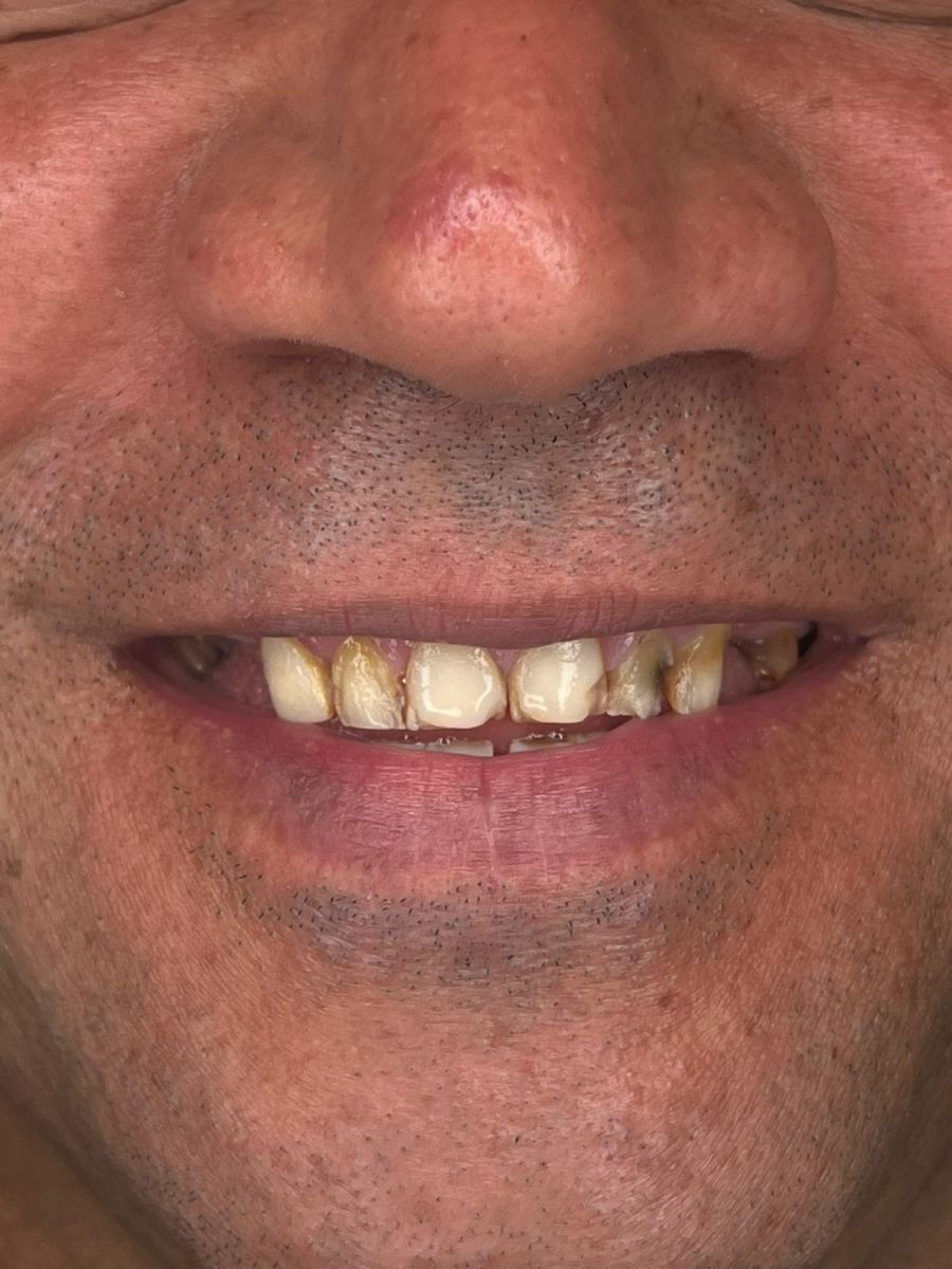 Porcelain veneers case 3, before treatment