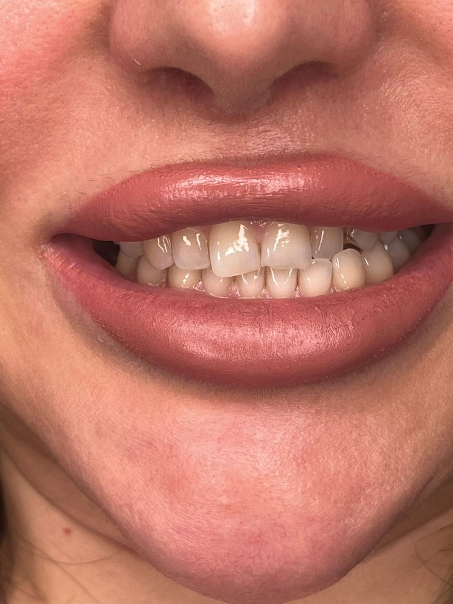 Porcelain veneers case 7, before treatment