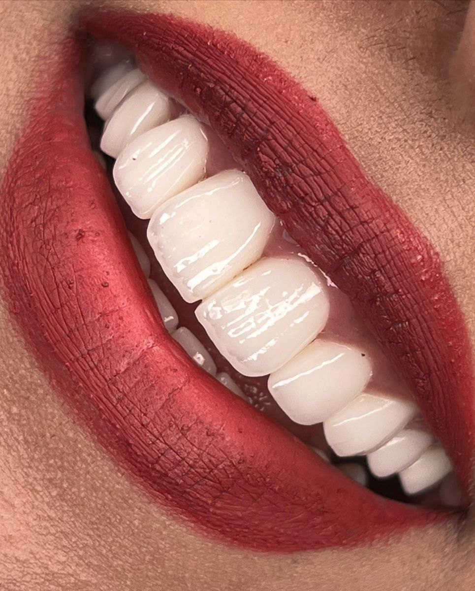 Porcelain veneers, after treatment