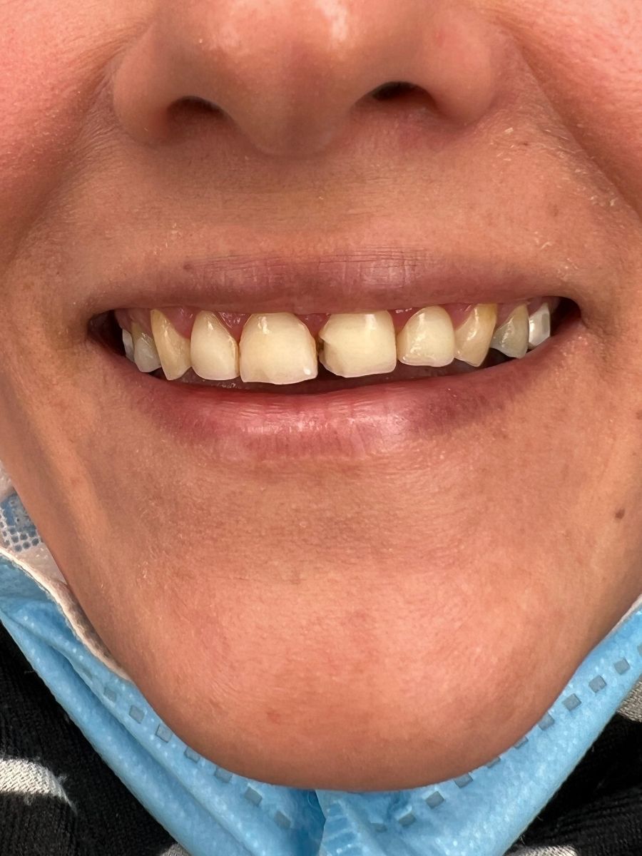 Composite bonding, before treatment